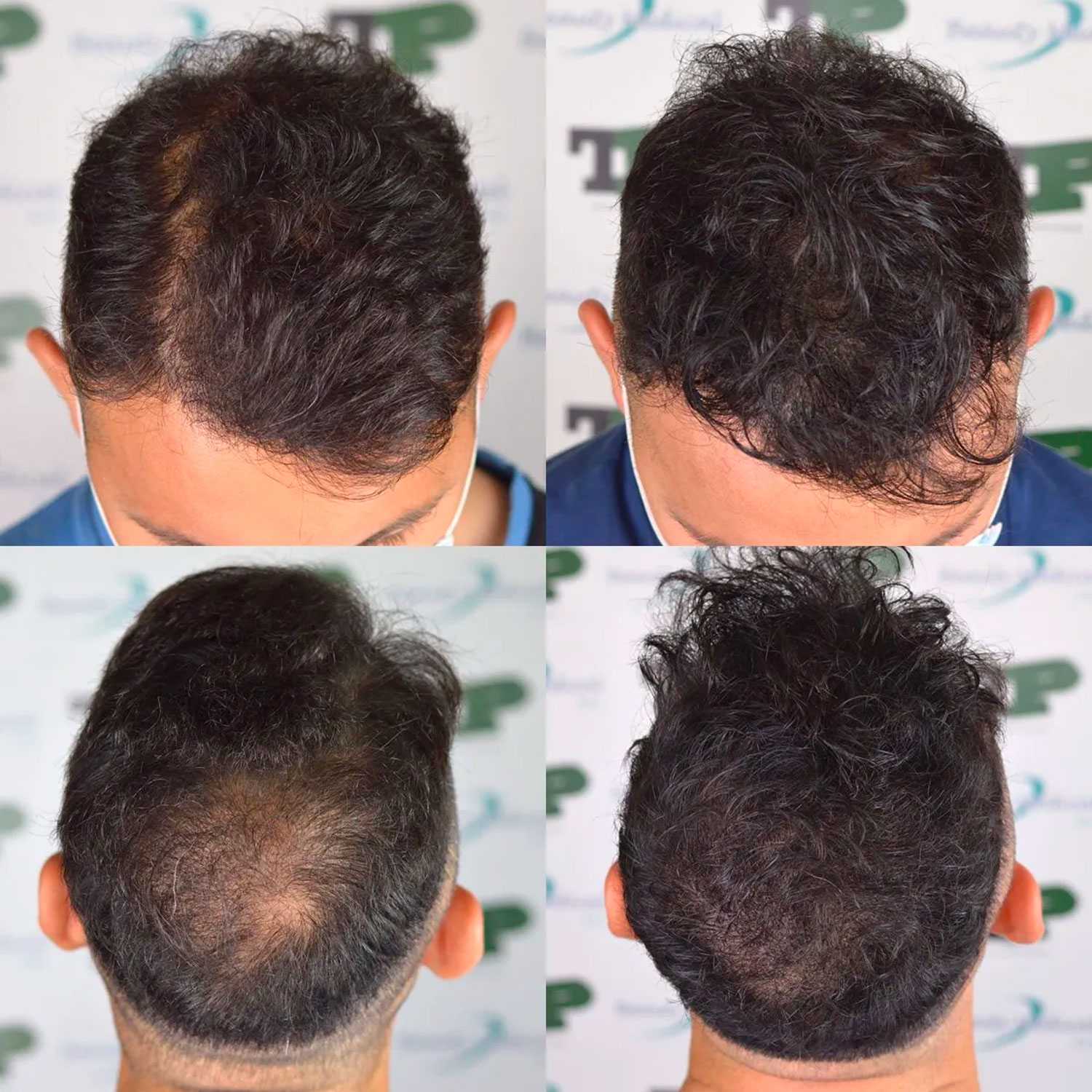 tricopigmentazione effetto densita tricopigmentazione effetto densita