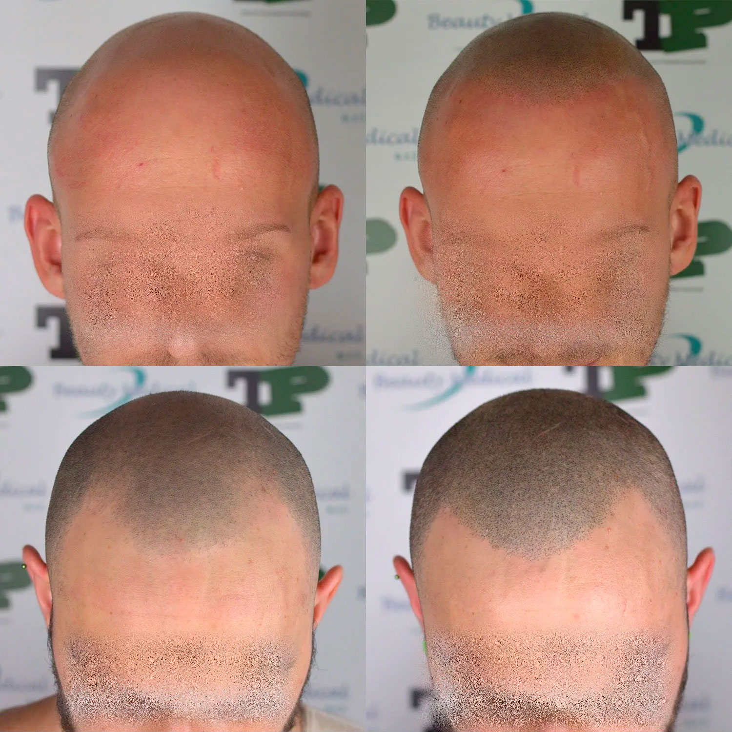 tricopigmentazione semipermanente e permanente tricopigmentazione semipermanente e permanente